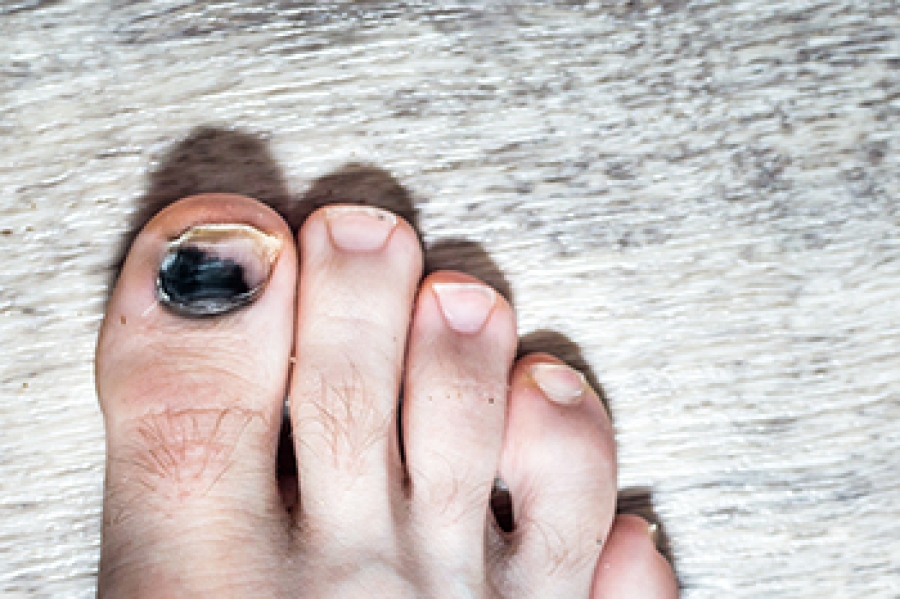 Black toenail: 6 potential causes