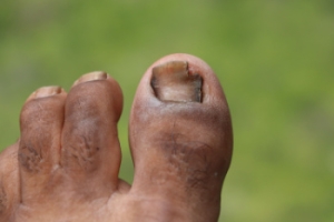 When Fungus Takes Over Your Toenail