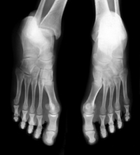 Bunions and X-ray Imaging