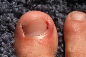 Cutting Ingrown Toenails