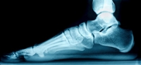 Possible Causes of Flat Feet
