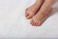 What Are Hammertoes?