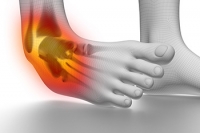 Facts About Chronic Ankle Sprains