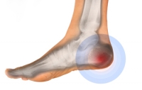 There Are Many Forms of Heel Pain