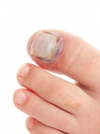 How a Broken Toe Is Diagnosed