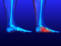 The Causes of Flat Feet