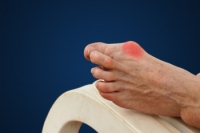 Causes of Bunions